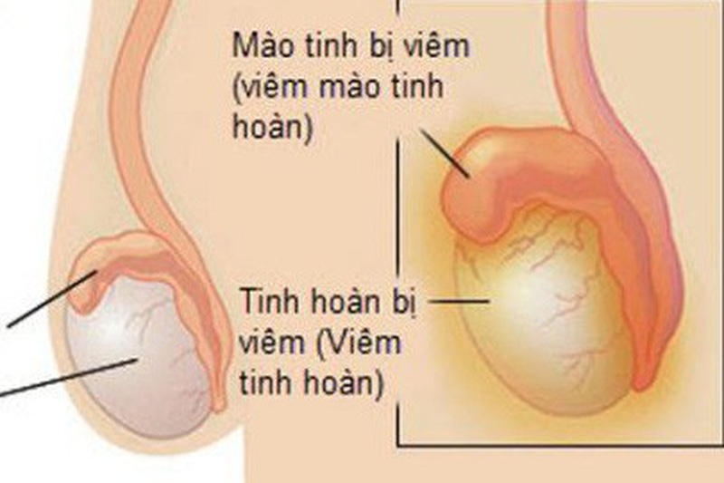 Viêm tinh hoàn: Biến chứng nguy hiểm nếu không điều trị kịp thời | VTV.VN