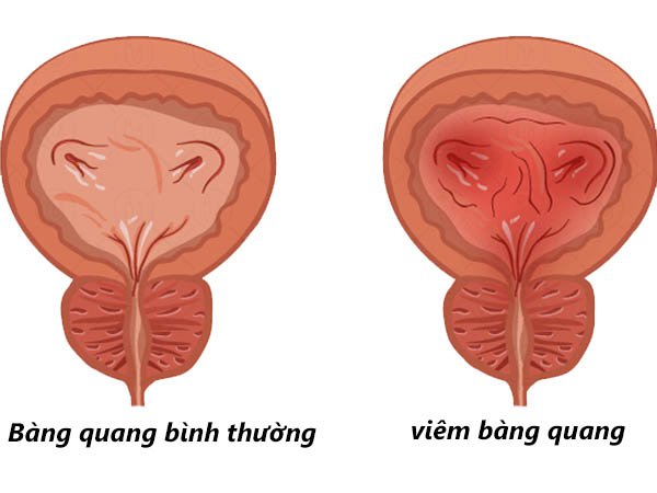 Viêm bàng quang và cách chữa trị hiệu quả nhất (Update 11/2020) - PHÒNG  KHÁM THỦ ĐÔ VĨNH PHÚC - Liferay