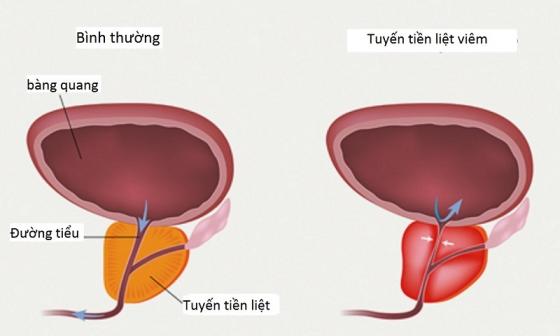 viem-tuyen-tien-liet-sapo.jpg